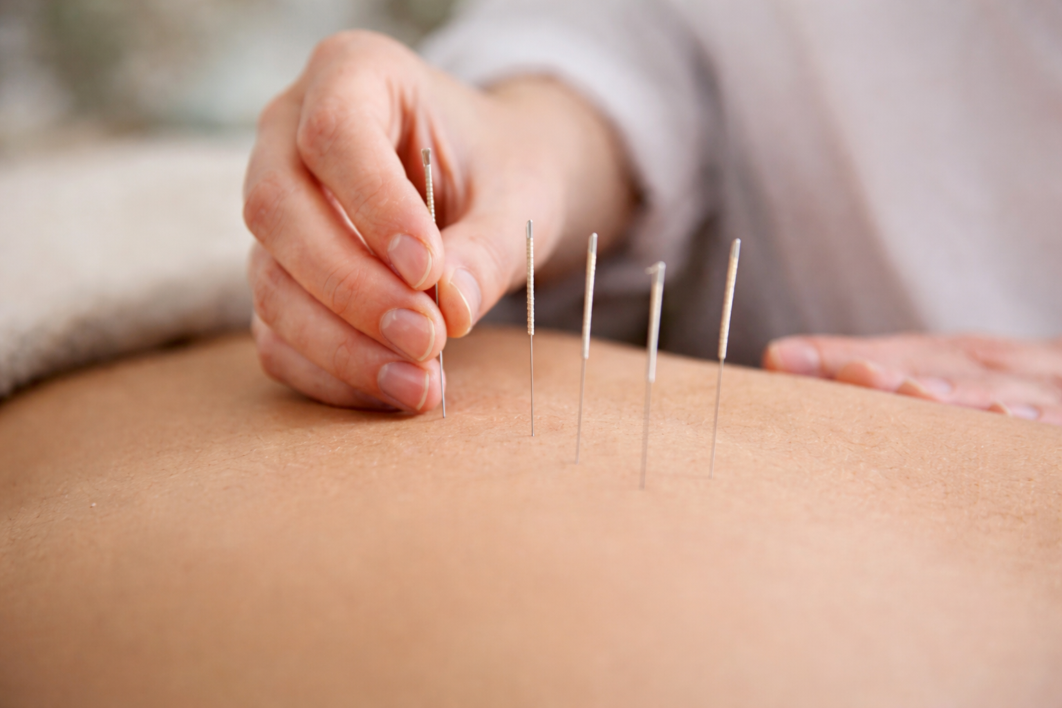Acupuncture