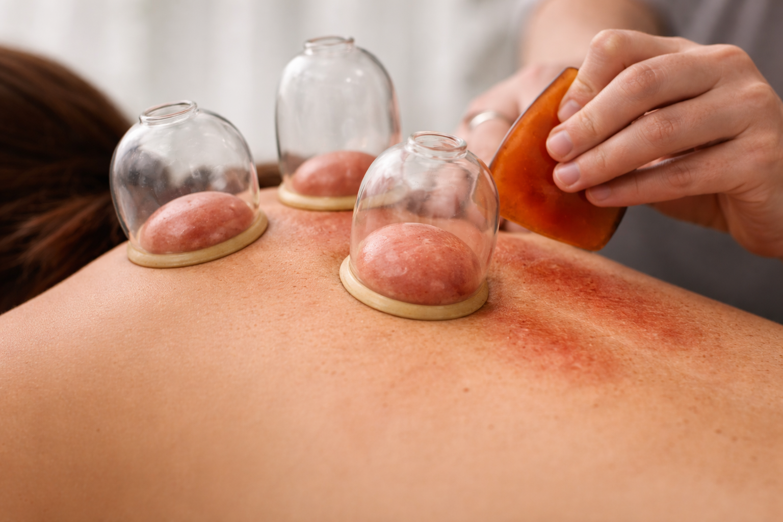 Cupping & Gua Sha